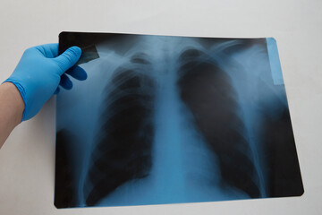 A hand in a blue medical glove holding a chest X-ray on a white background. Lung diseases, disease...