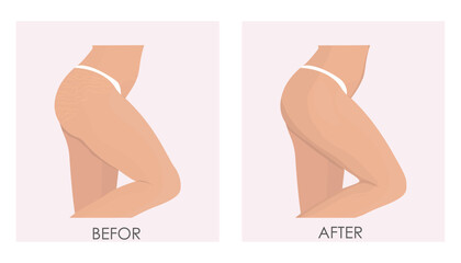 Vector illustration of treatment of stretch marks and stretch marks using cosmetic and laser techniques. Female buttocks before and after treatment. - obrazy, fototapety, plakaty