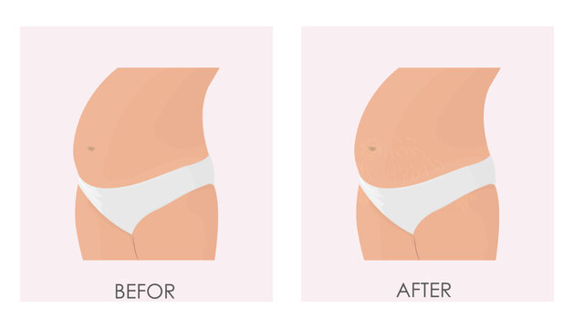 Vector illustration of treatment of stretch marks and stretch marks using cosmetic and laser techniques. The appearance of body imperfections during pregnancy.