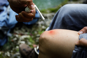Medication With of Unknown Puncture on Woman Leg in Wilderness With Disinfectant First Aid Kit Spray