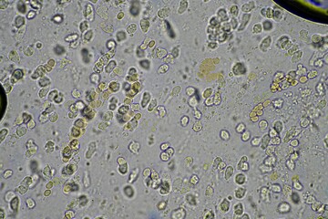 Coughing up mucus and phlegm from a chest infection from a virus and bacteria infection, looking at it under the microscope, with cells and microorganisms. Bacteria and skin cells close up