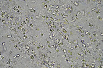 Coughing up mucus and phlegm from a chest infection from a virus and bacteria infection, looking at it under the microscope, with cells and microorganisms. Bacteria and skin cells close up