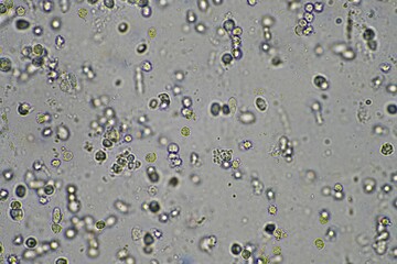 Coughing up mucus and phlegm from a chest infection from a virus and bacteria infection, looking at it under the microscope, with cells and microorganisms. Bacteria and skin cells close up