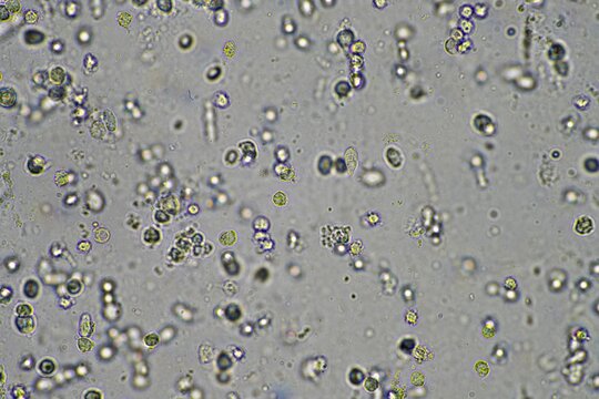 Coughing up mucus and phlegm from a chest infection from a virus and bacteria infection, looking at it under the microscope, with cells and microorganisms. Bacteria and skin cells close up