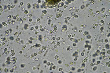 Coughing up mucus and phlegm from a chest infection from a virus and bacteria infection, looking at...