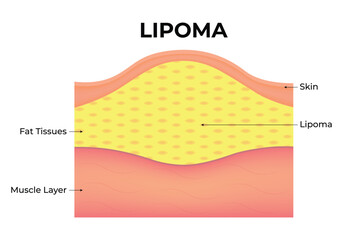 Lipoma Science Design Vector Illustration Diagram