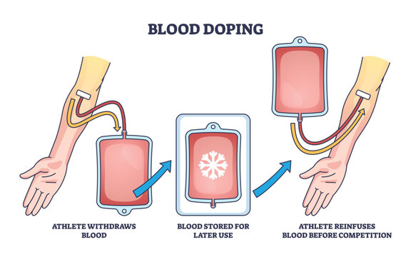 Blood doping principle with athlete reinfusion for strength and power outline diagram. Labeled educational scheme with cheating process to illegally inject blood before competition. Performance boost
