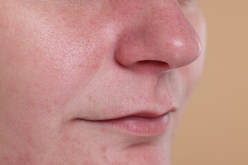 Fototapeta premium Closeup view of woman with blackheads on her nose against beige background