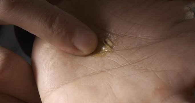 Top view: dropsy on the palm of the hand is sealed with biological glue. Skin damage. Pain