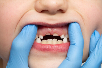 Losing primary teeth or milk teeth change. Close-up of fallen baby teeth on the upper jaw. Swelling of the gums. Dentist in blue medical gloves examines a child's oral cavity. Oral care concept - obrazy, fototapety, plakaty