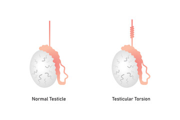 Testicular Torsion Disease Scientific Design. Vector Illustration. - obrazy, fototapety, plakaty