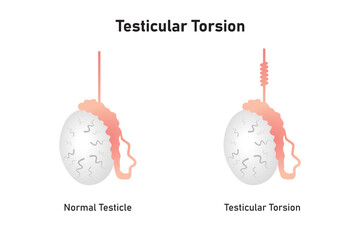 Testicular Torsion Disease Scientific Design. Vector Illustration.