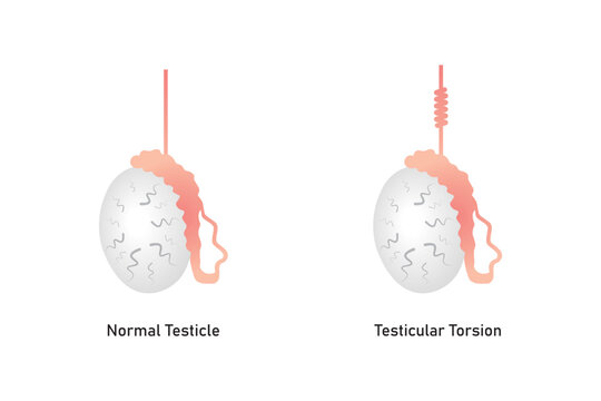 Testicular Torsion Disease Scientific Design. Vector Illustration.