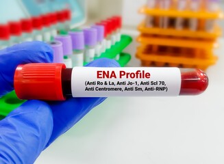 Blood sample and stethoscope isolated on ENA profile test report. extractable nuclear antigen,...