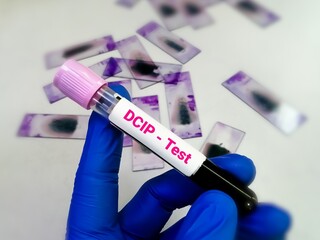 Blood sample tube for DCIP (dichlorophenol indophenol precipitation) test, thalassemia hemoglobin E...