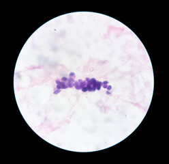 Ascetic fluid cytology, Malignant cells, Metastatic adenocarcinoma