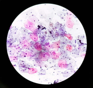 Photomicrograph of Paps smear: Inflammatory smear with HPV related changes. Cervical cancer. SCC