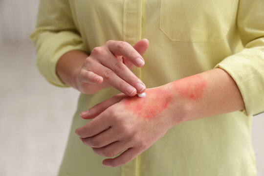 Woman applying healing cream onto burned hand indoors, closeup
