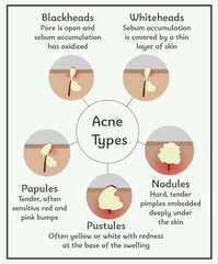 Acne types. Medical illustration. Infographic about skin and dermatology. An illustration for the study of inflammatory skin diseases. Treatment of acne. Stages of acne development. Detailed dermatolo