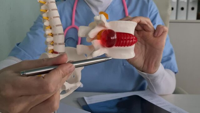 Closeup of female doctor hand with artificial disc herniation and spine model. Treatment of herniated discs and diseases of spine