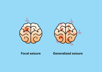 Illustration of seizure types demonstrating by onset and brain waves.