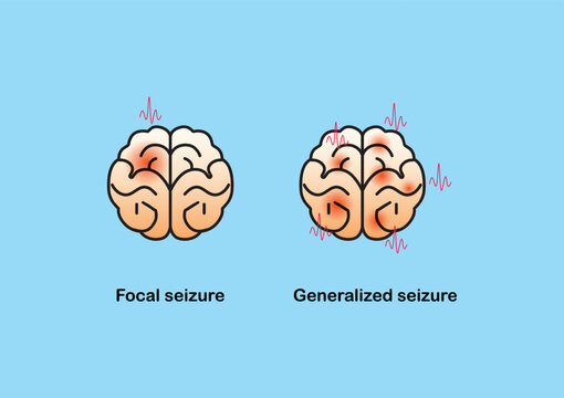 Illustration of seizure types demonstrating by onset and brain waves.