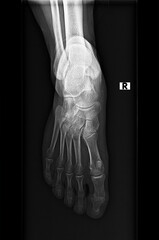 Normal radiography, xray or x-ray of the foot and ankle joint in anteroposterior (AP) projection,...