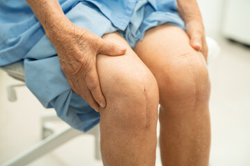 Asian elderly woman patient show her scars surgical total knee joint replacement Suture wound...