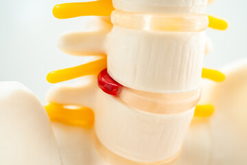 Lumbar spine displaced herniated disc fragment, spinal nerve and bone. Model for treatment medical...