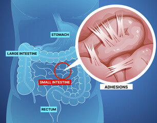 Bowel obstruction. Adhesions. Fibrous bands that form between tissues and organs. Infographic. Healthcare illustration. Vector illustration. 