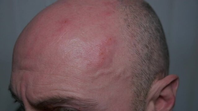 50fps. Man with painful shingles virus. Lumps and blisters on his head. 