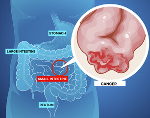 Bowel obstruction. Cancer. Infographic. Healthcare illustration. Vector illustration. 