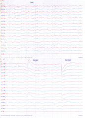 EEG Report, awake, eye open eye closed test, 56 years Male