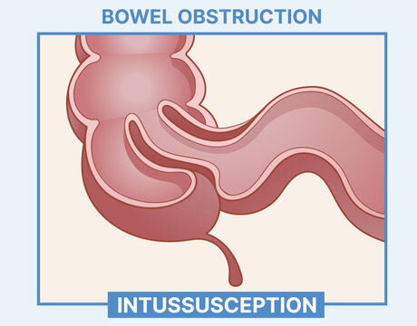 Bowel obstruction. Intussusception. Healthcare illustration. Vector illustration. 