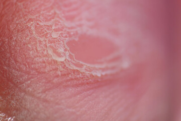 Macro texture of dried foot skin 
