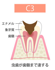 C3 虫歯が歯髄まで達する