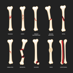 Set of different types of bone fracture collection, Diagram of leg fracture in different stages for infographic biology education school, Femur Bones, human anatomy poster. - obrazy, fototapety, plakaty