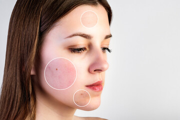 Female face with skin problems on gray background. Acne, wrinkles and enlarged pores.