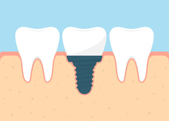 Dental prosthetics concept. Gums and dental implant flat vector illustration.