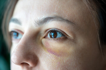 Beaten abused helpless scared wife with eye hematoma experiencing domestic violence, aggression,...