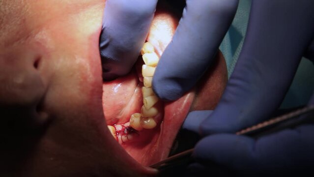 Dental implant surgery for a patient in a dental office. The doctor screws a metal implant into the jaw.