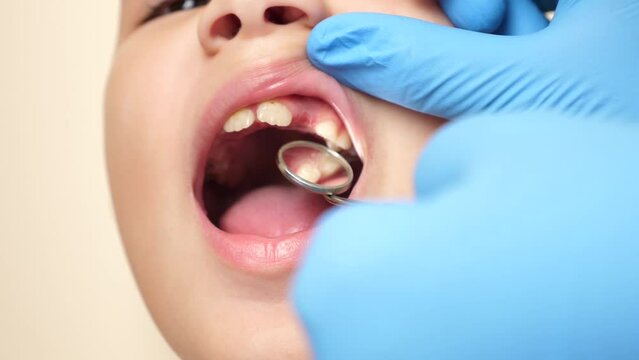 The doctor examines the oral cavity of a child with a missing tooth using a dental mirror. Healthcare and dental care concept. Slow motion.