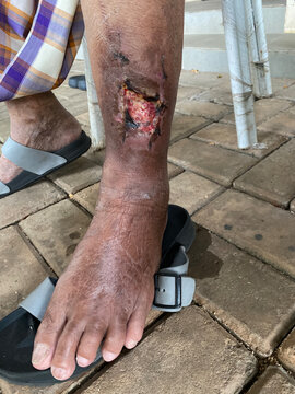 Old foot Pasca debridement treatment of infected wound of diabetes foot medical with inflammation effect and sewing wounds, blood tissue healing skin
