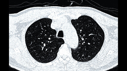 CT scan of Chest or lung  axial view for screening lung nodules