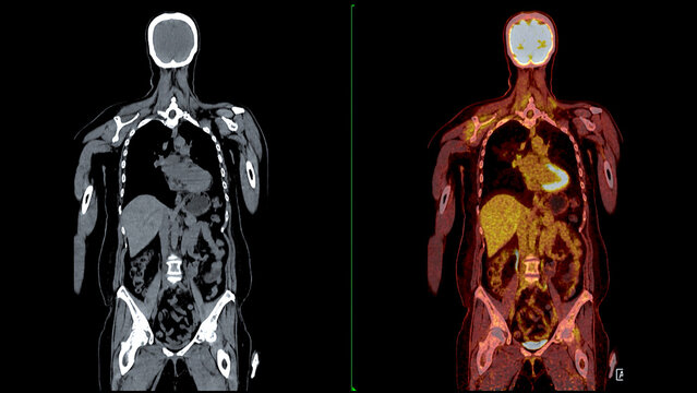 PET CT Scan fusion image It provides detailed images by merging