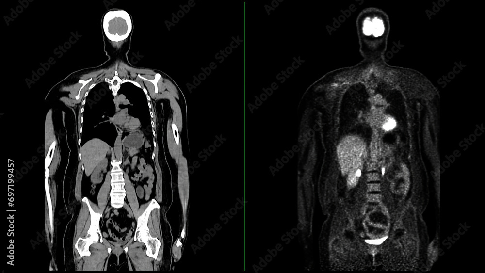 Poster pet ct scan fusion image it provides detailed images by merging