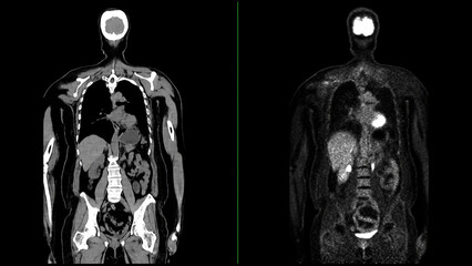 PET CT Scan fusion image It provides detailed images by merging - obrazy, fototapety, plakaty