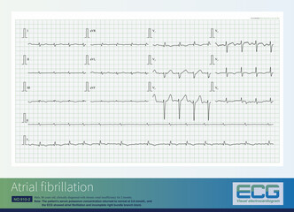 This was another ECG in patients with hyperkalemia after potassium normalizes and suggested atrial fibrillation and incomplete right bundle branch block.