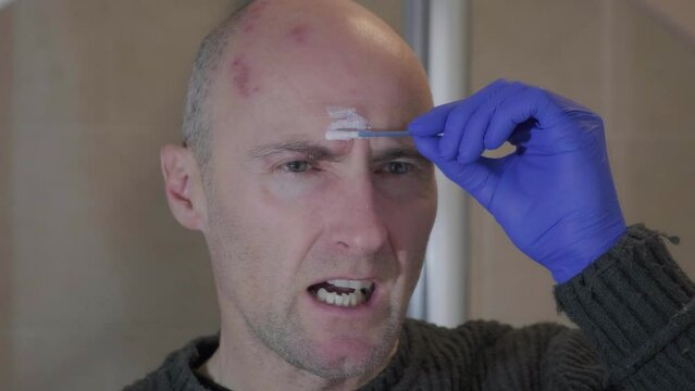 Man with painful shingles virus. Scabs and blisters on his face, head and above his eye. Reflection in bathroom mirror. Treating with calamine lotion.