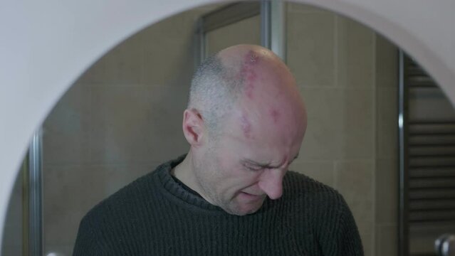 Man with painful shingles virus. Scabs and blisters on his face and head. 
